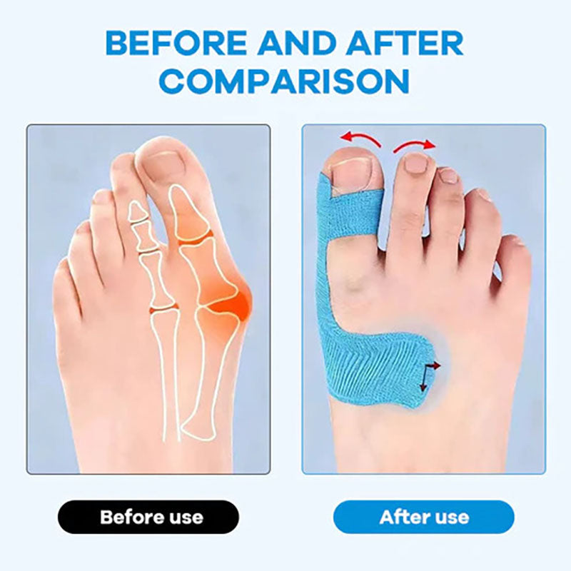 🔥Last Day Buy 1 Get 1🔥Bunion Correction Muscle Tape👣（Make Your Feet More Comfortable）