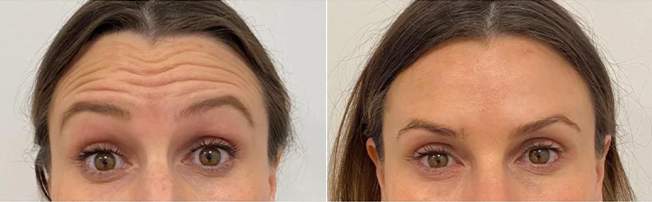 Customer forehead fine line before and after routine photo