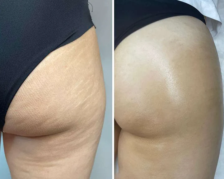 Customer body skin before and after routine photo