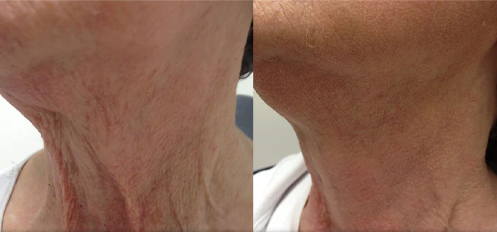 Customer neck skin before and after routine photo
